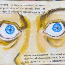 Exopthalmos.jpeg