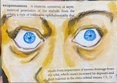 Exopthalmos.jpeg